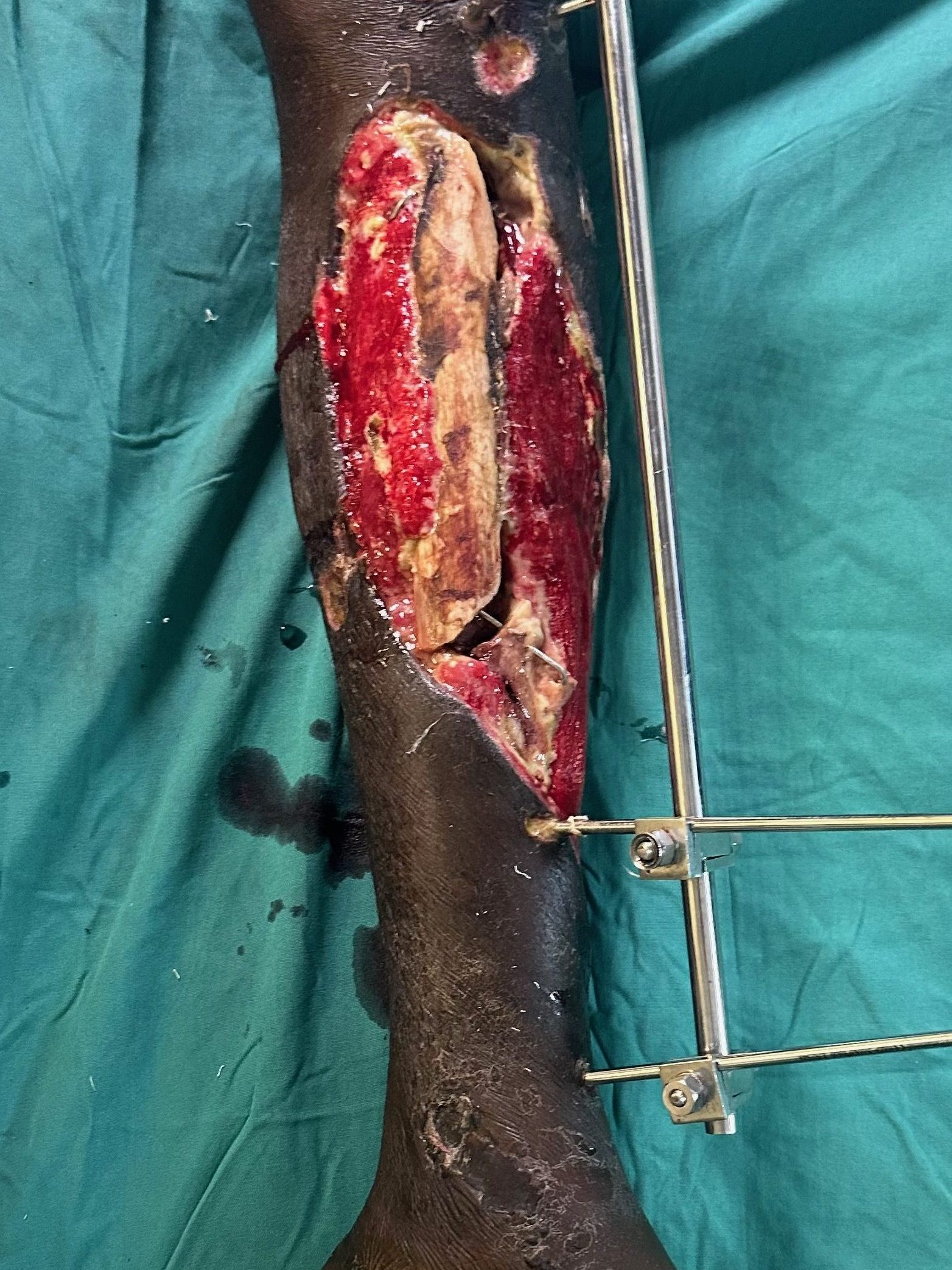 Orthopaedic Infection